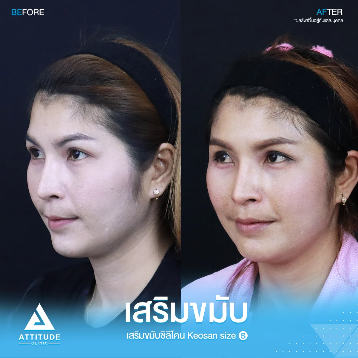 เสริมขมับ