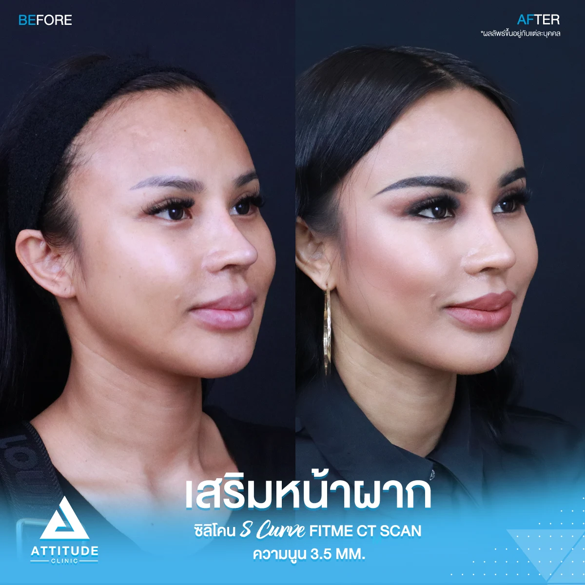 เสริมหน้าผาก