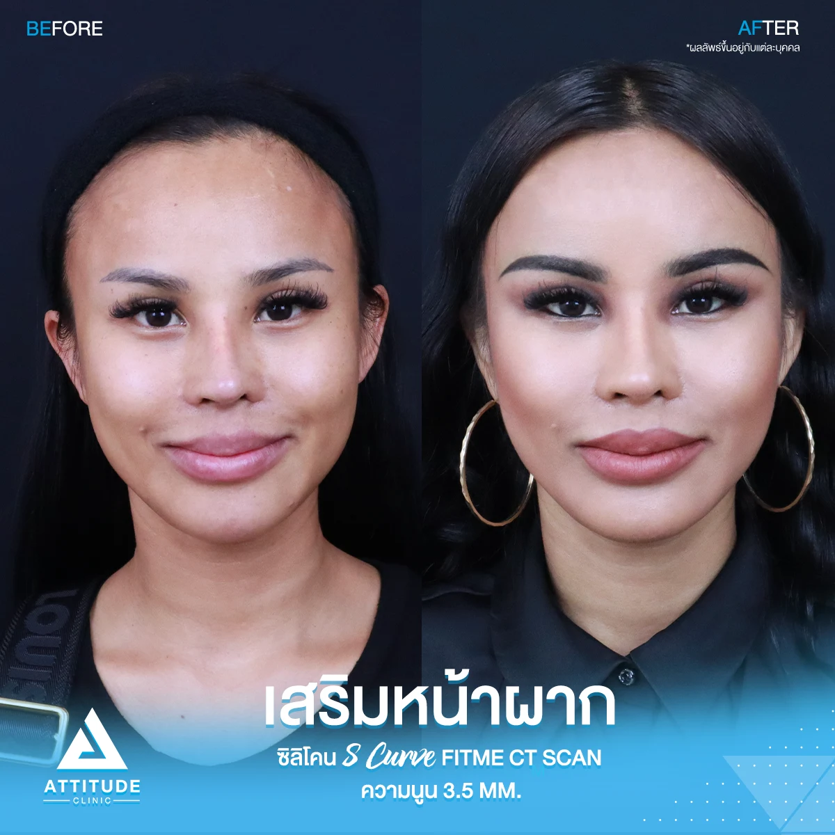 เสริมหน้าผาก