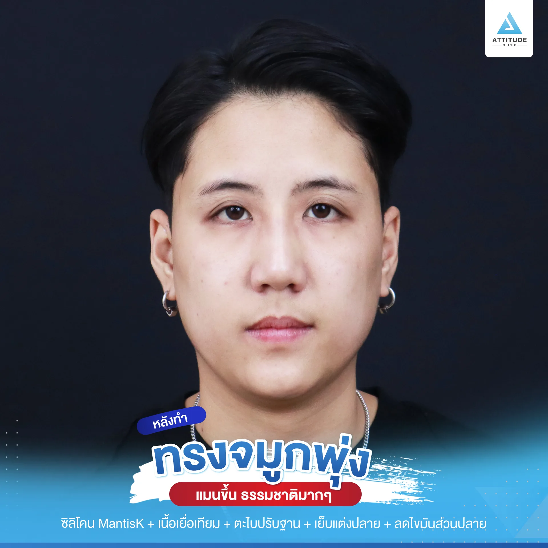 เสริมจมูก