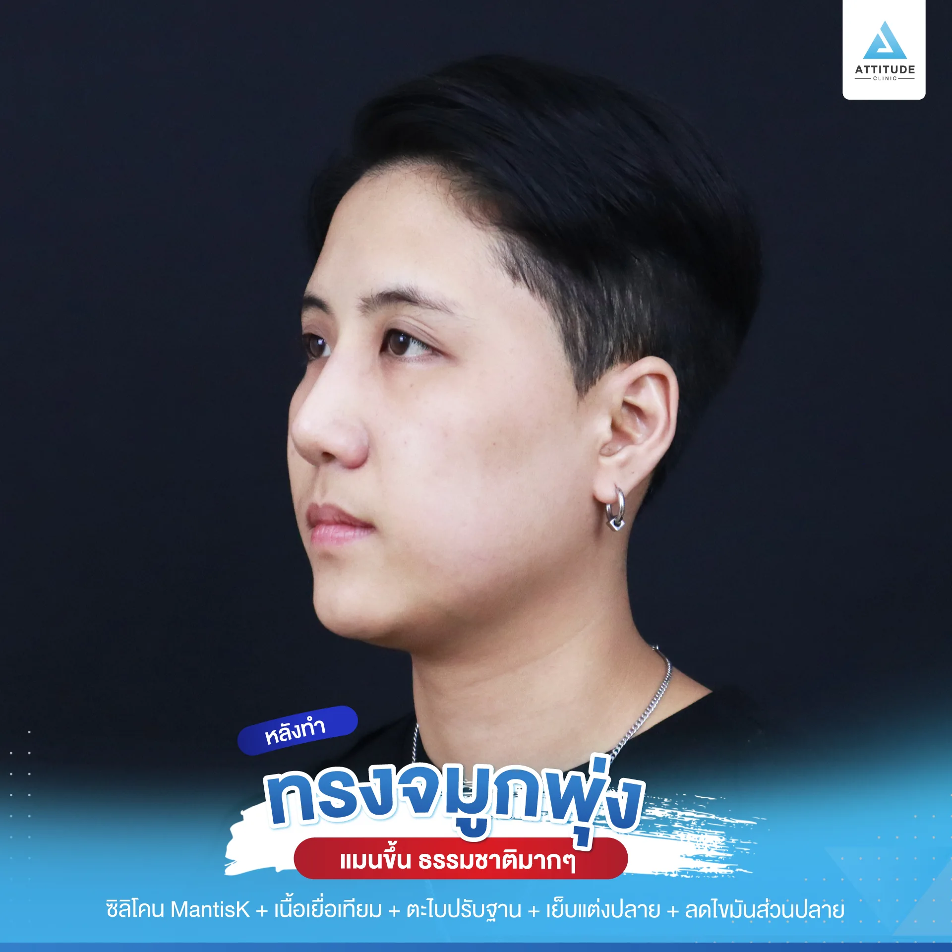 เสริมจมูก