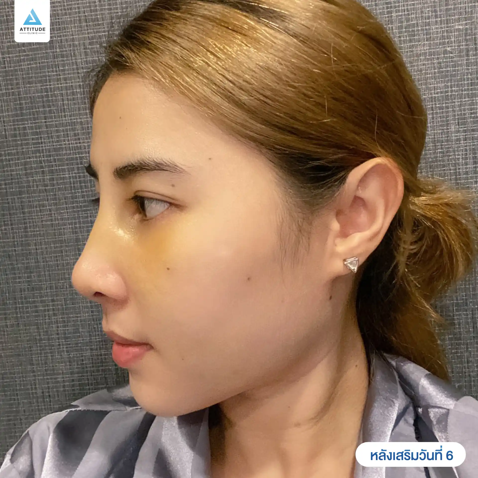 เสริมจมูก