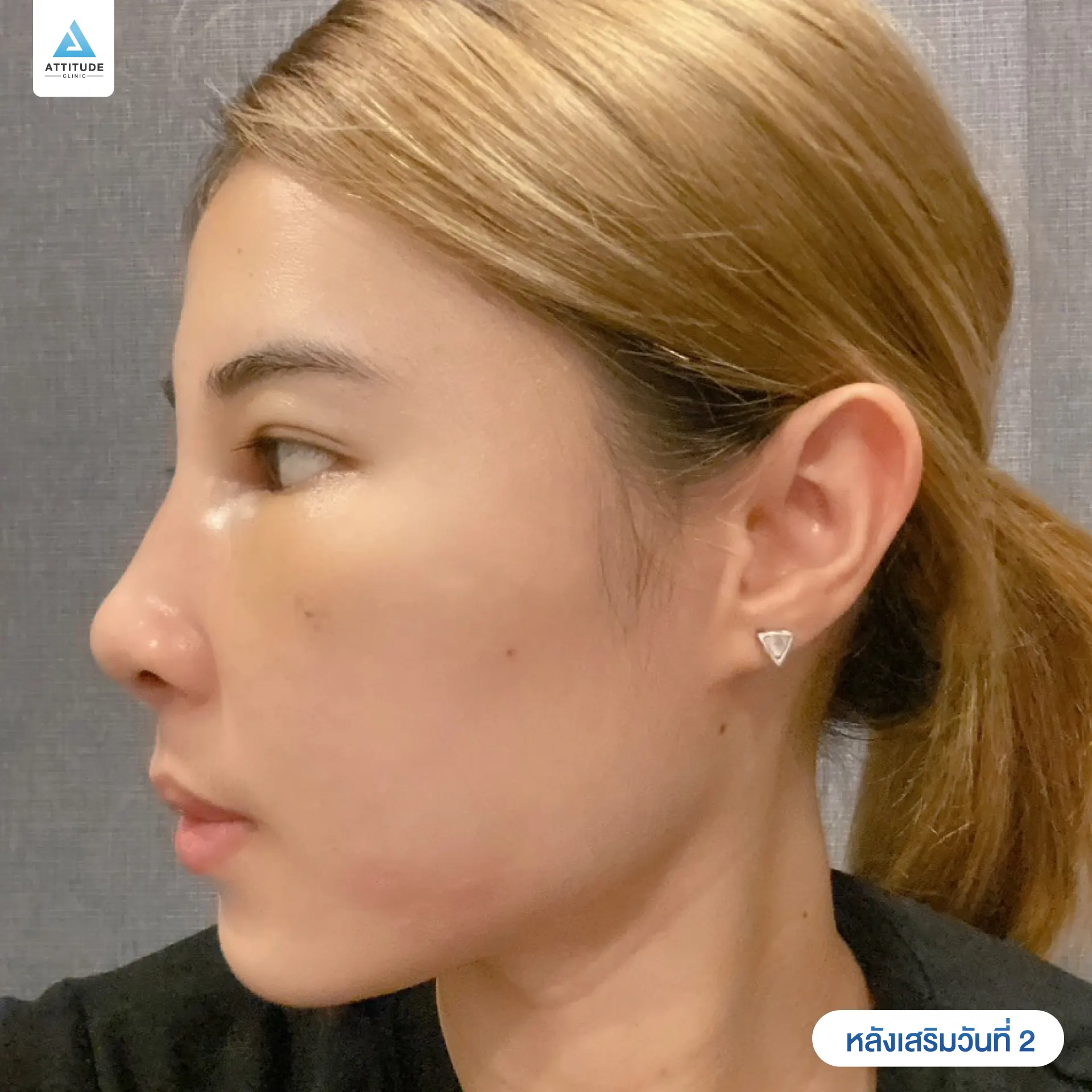 เสริมจมูก