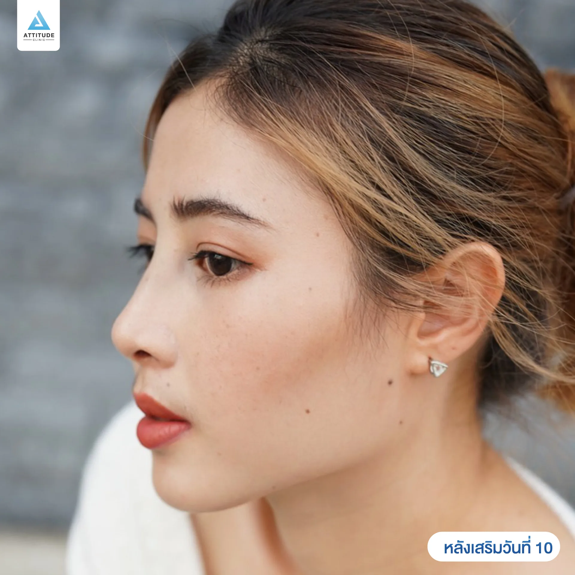 เสริมจมูก