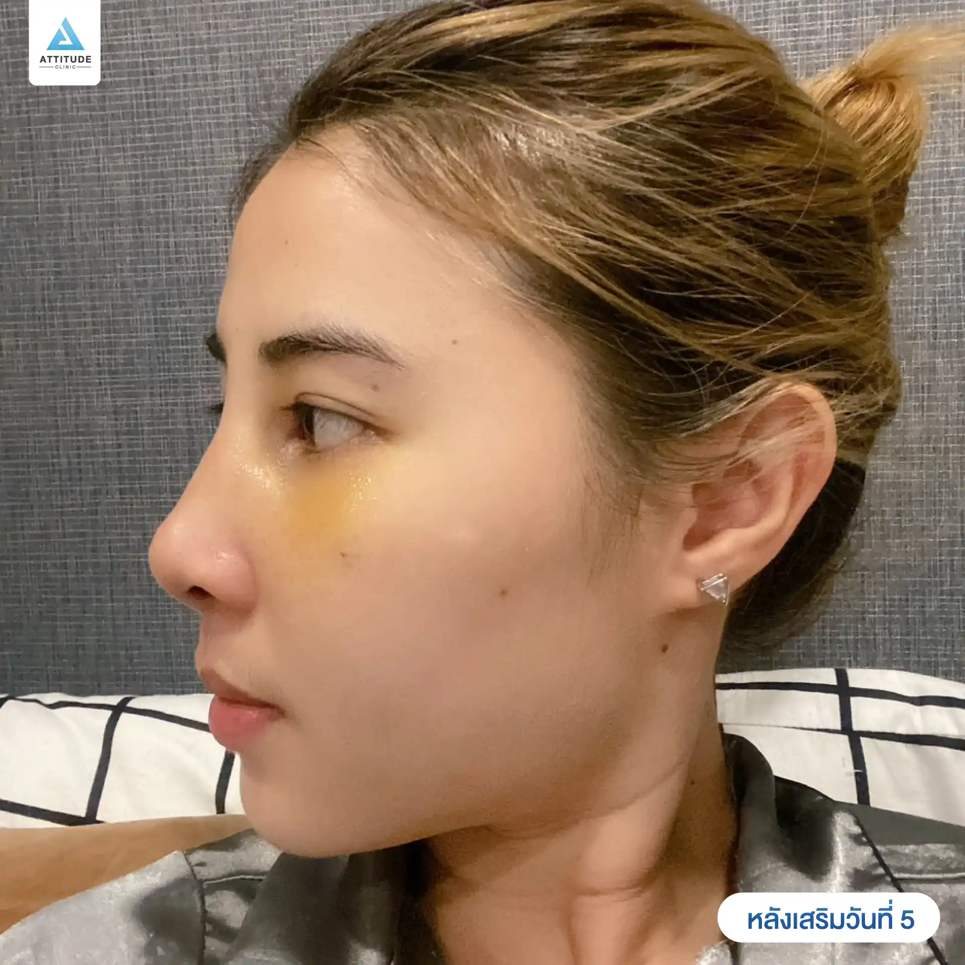 เสริมจมูก
