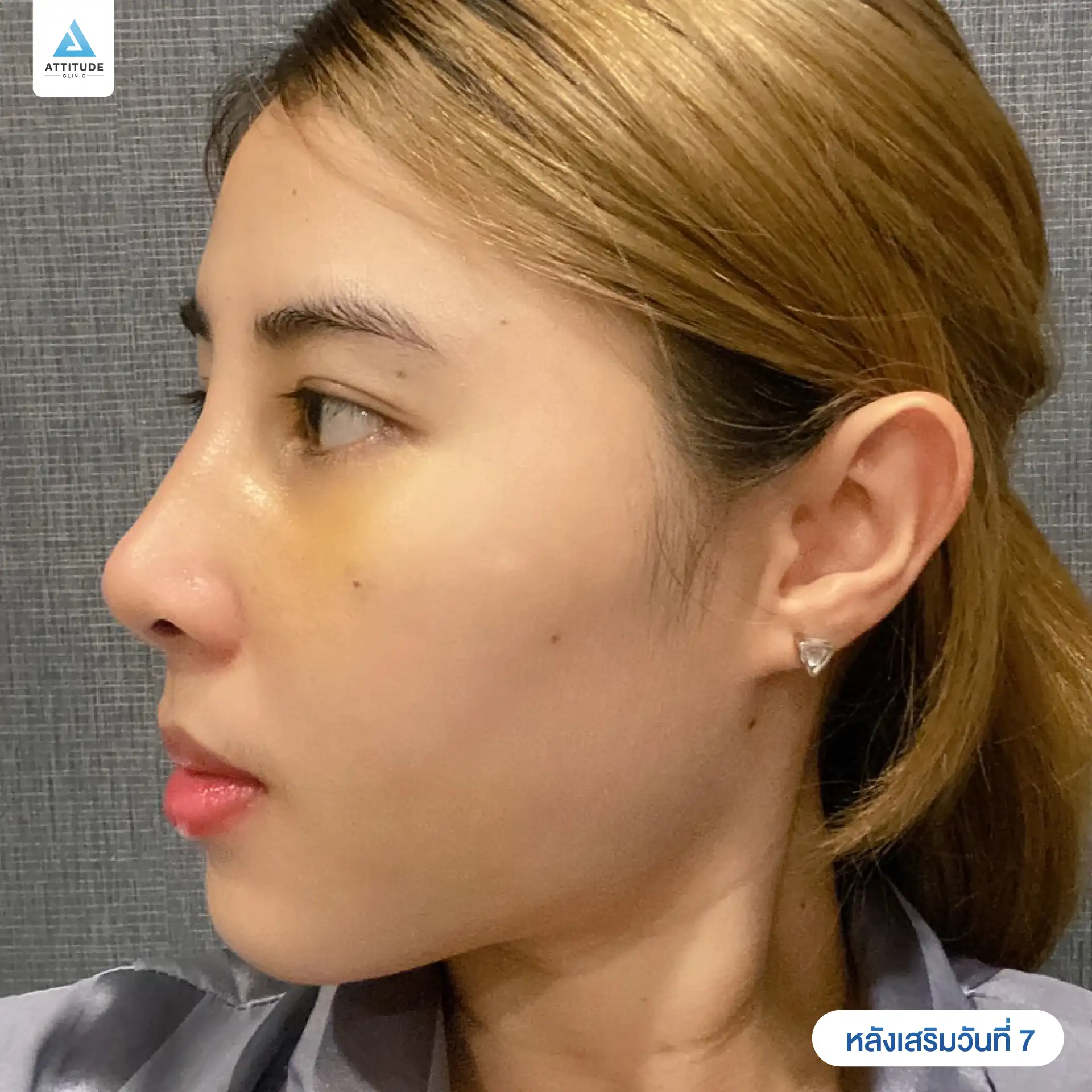 เสริมจมูก