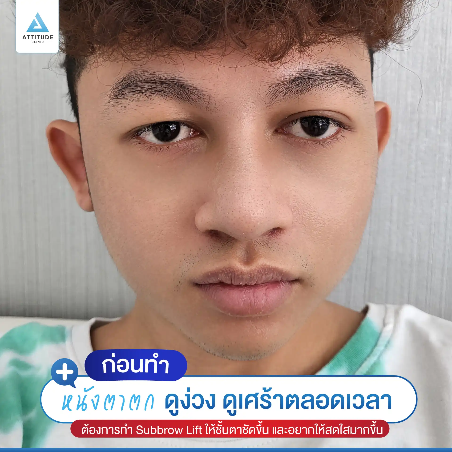 Sub Brow Lift