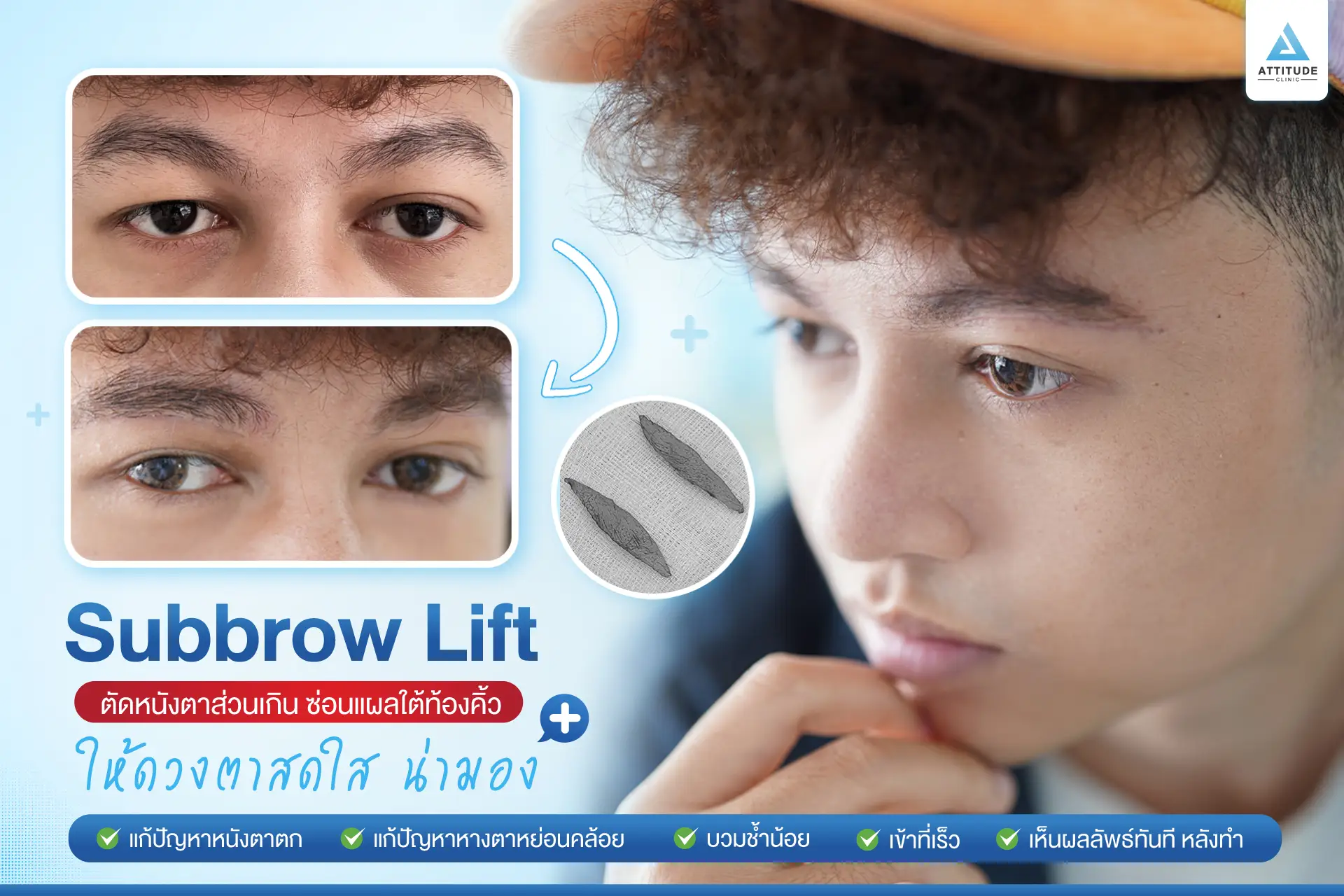 Sub Brow Lift