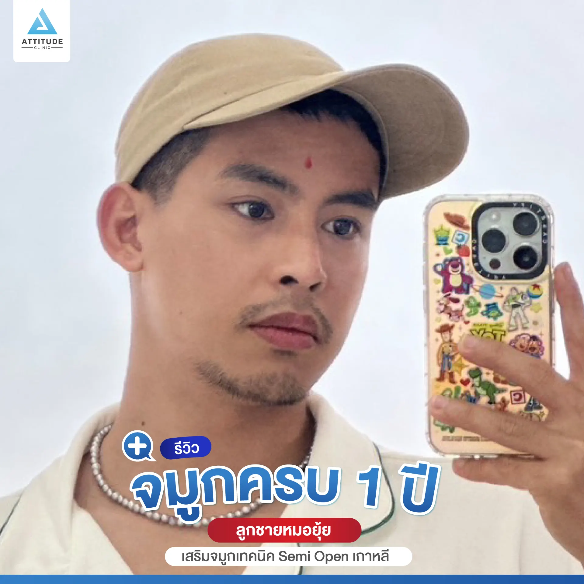 เสริมจมูก