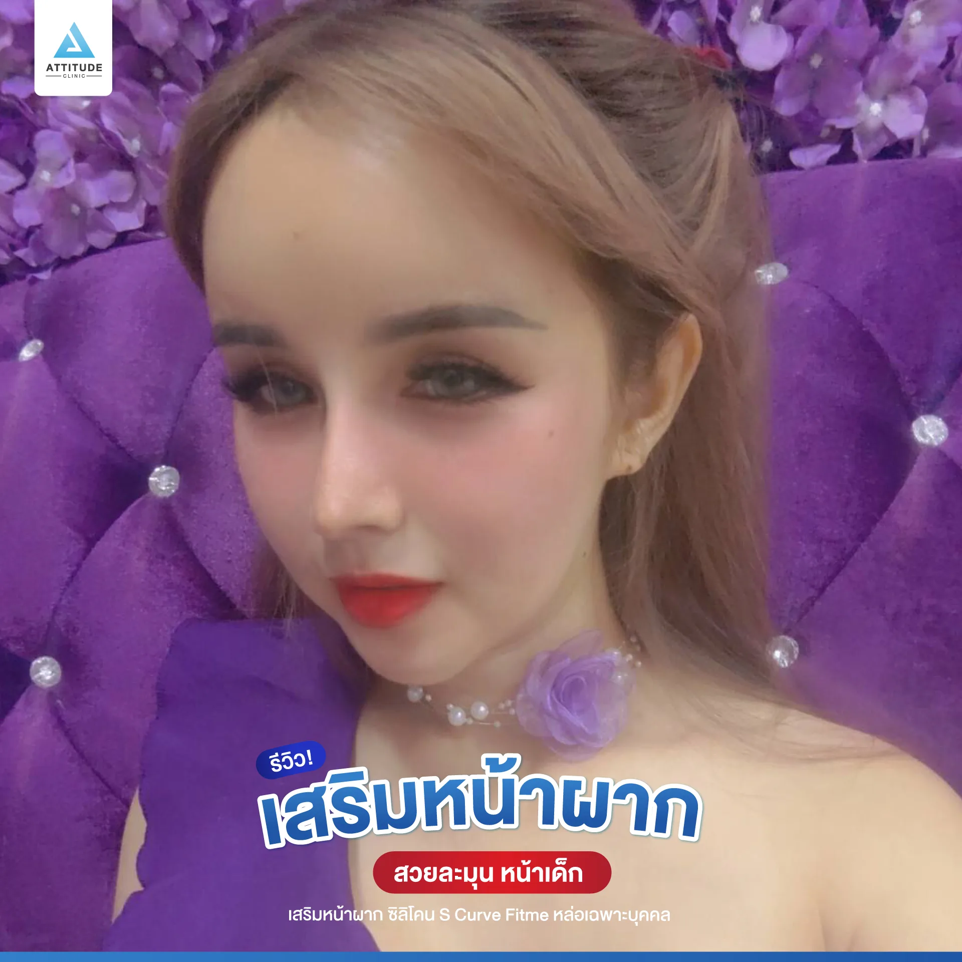 เสริมหน้าผาก