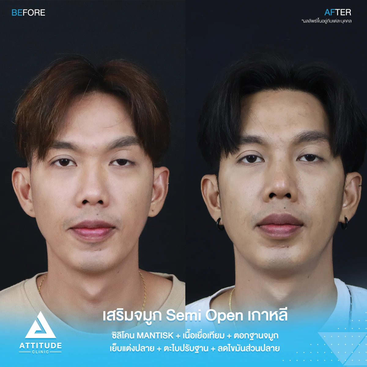 เสริมจมูก