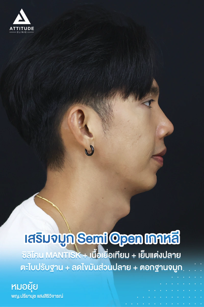 เสริมจมูก