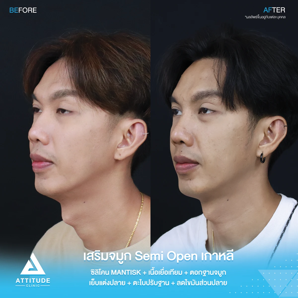 เสริมจมูก