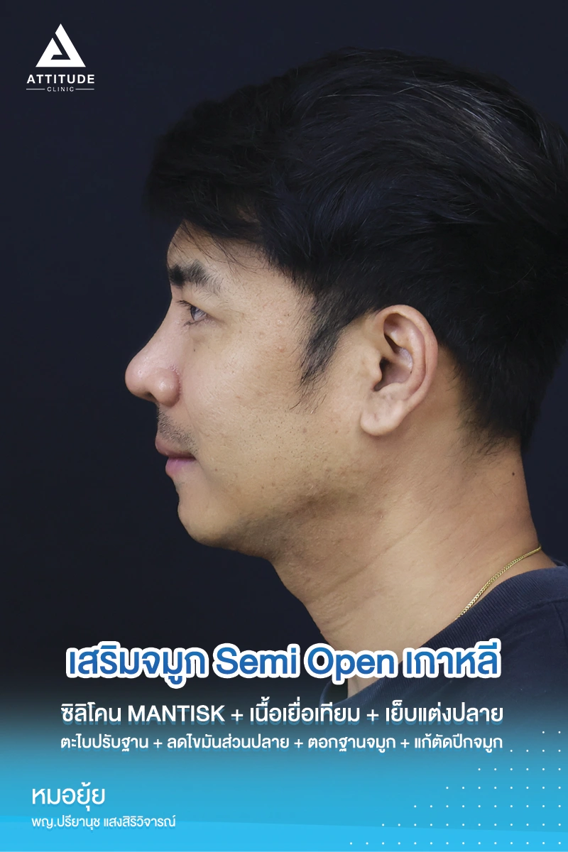 เสริมจมูก
