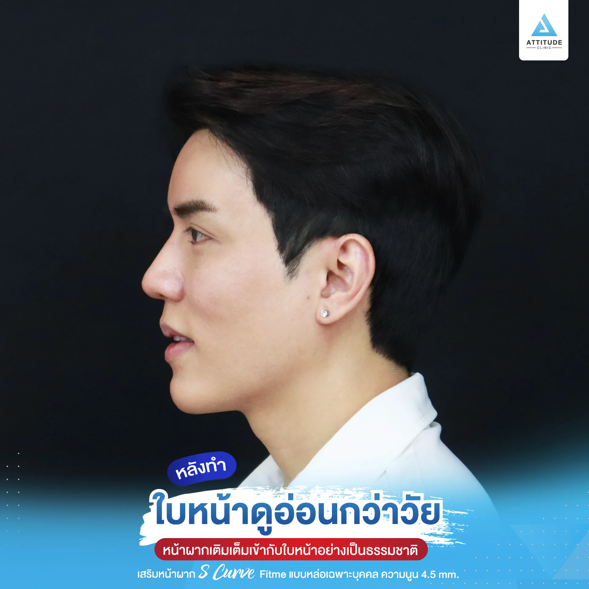เสริมหน้าผาก