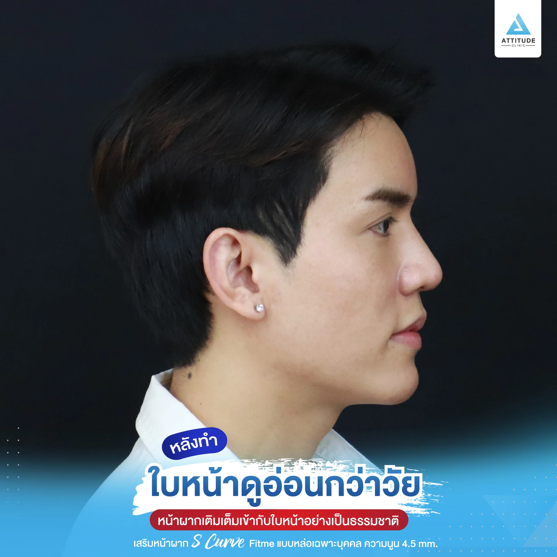 เสริมหน้าผาก