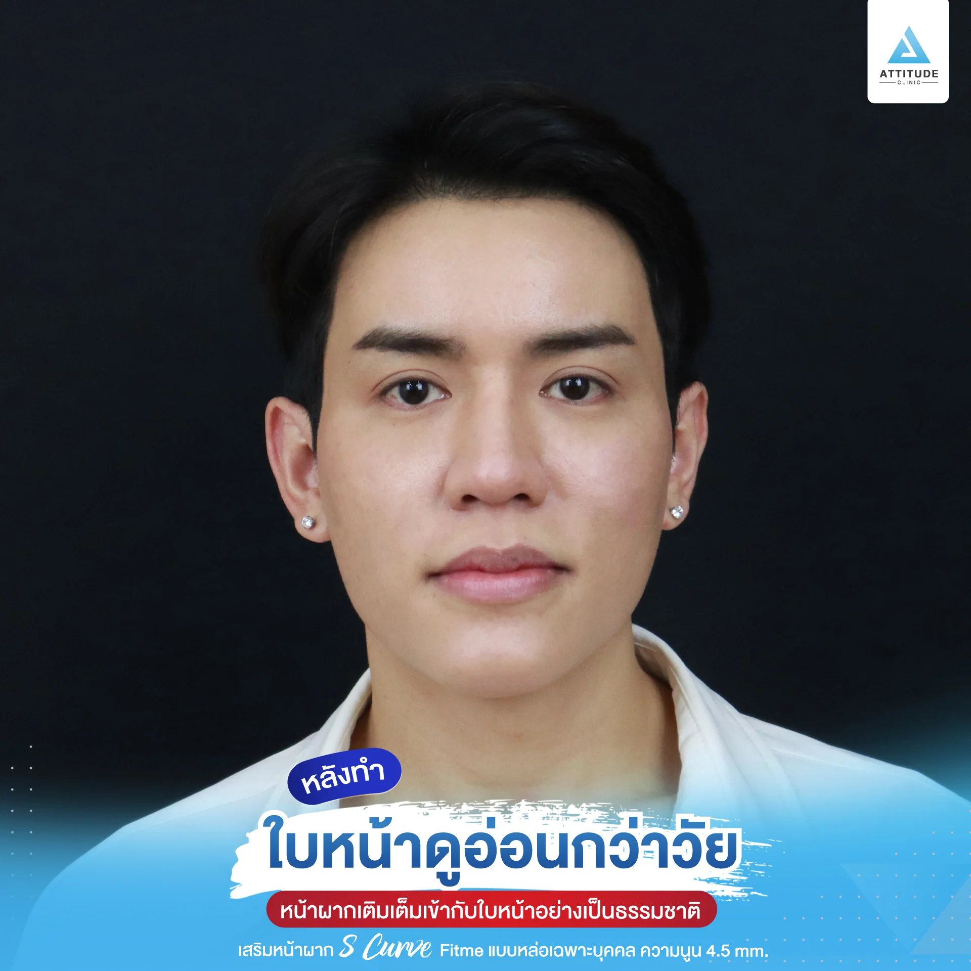 เสริมหน้าผาก