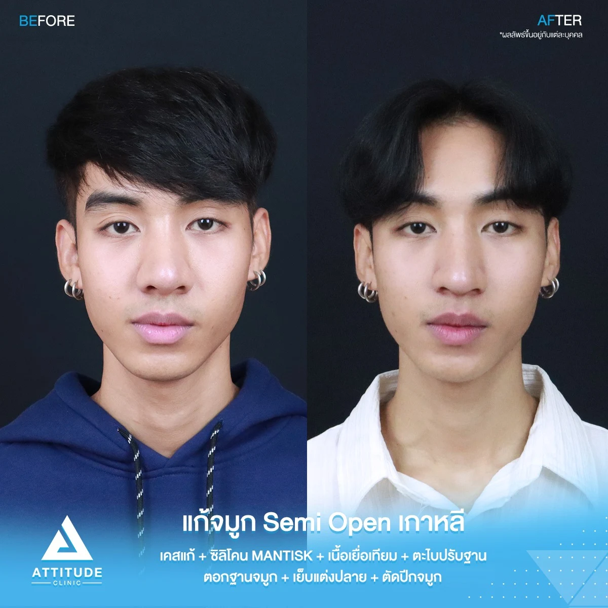แก้จมูก
