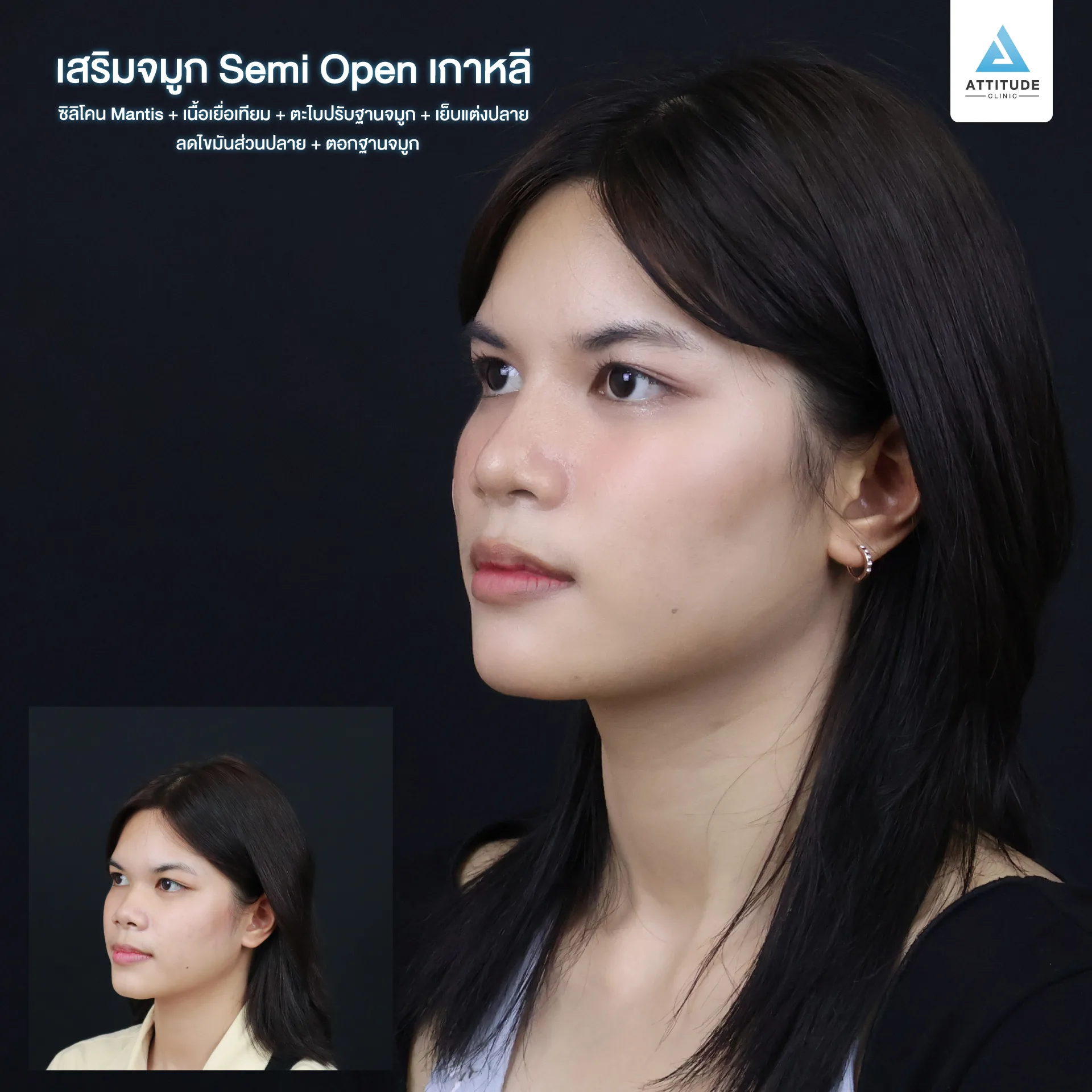 เสริมจมูก