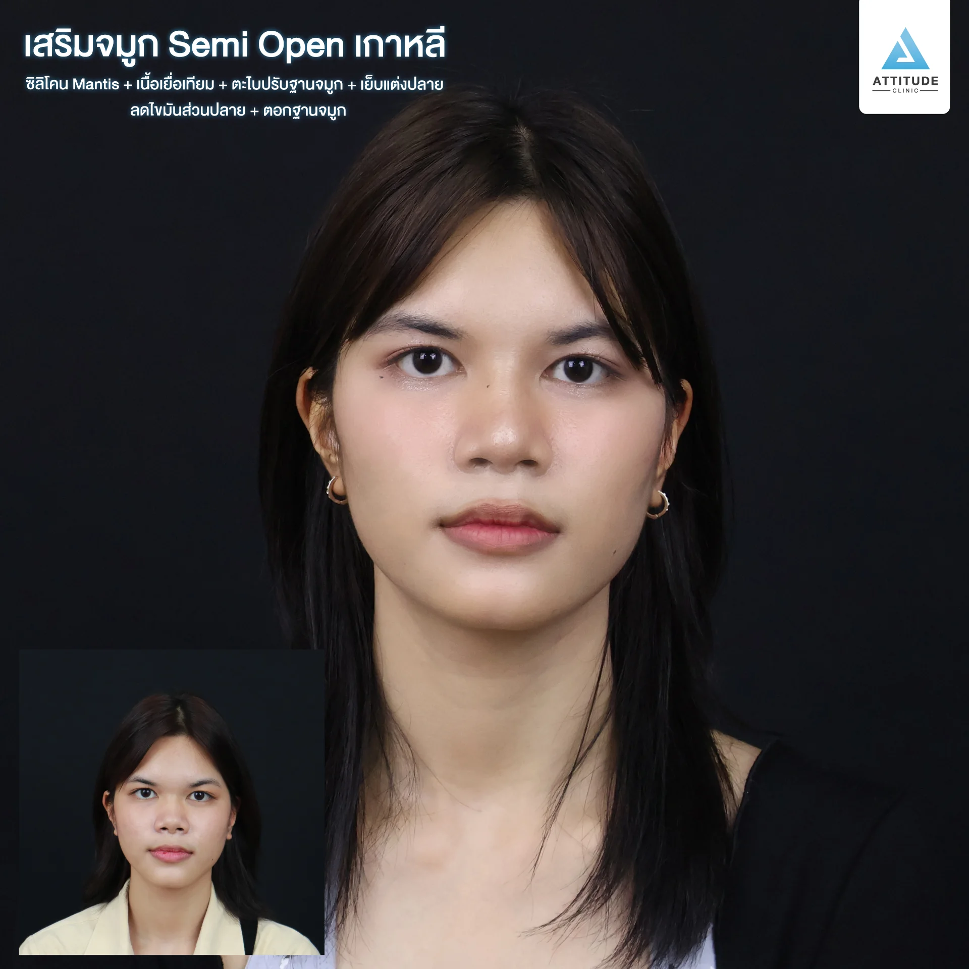 เสริมจมูก