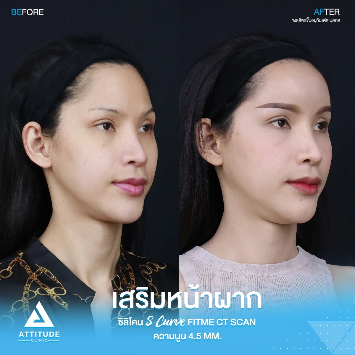 เสริมหน้ผาก