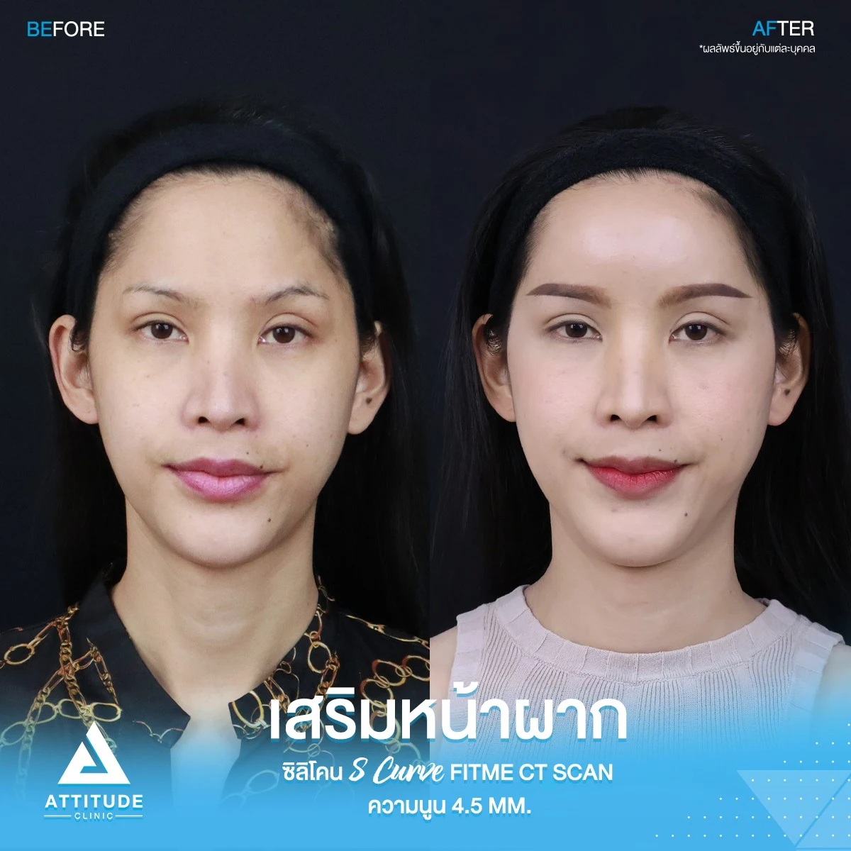 เสริมหน้ผาก