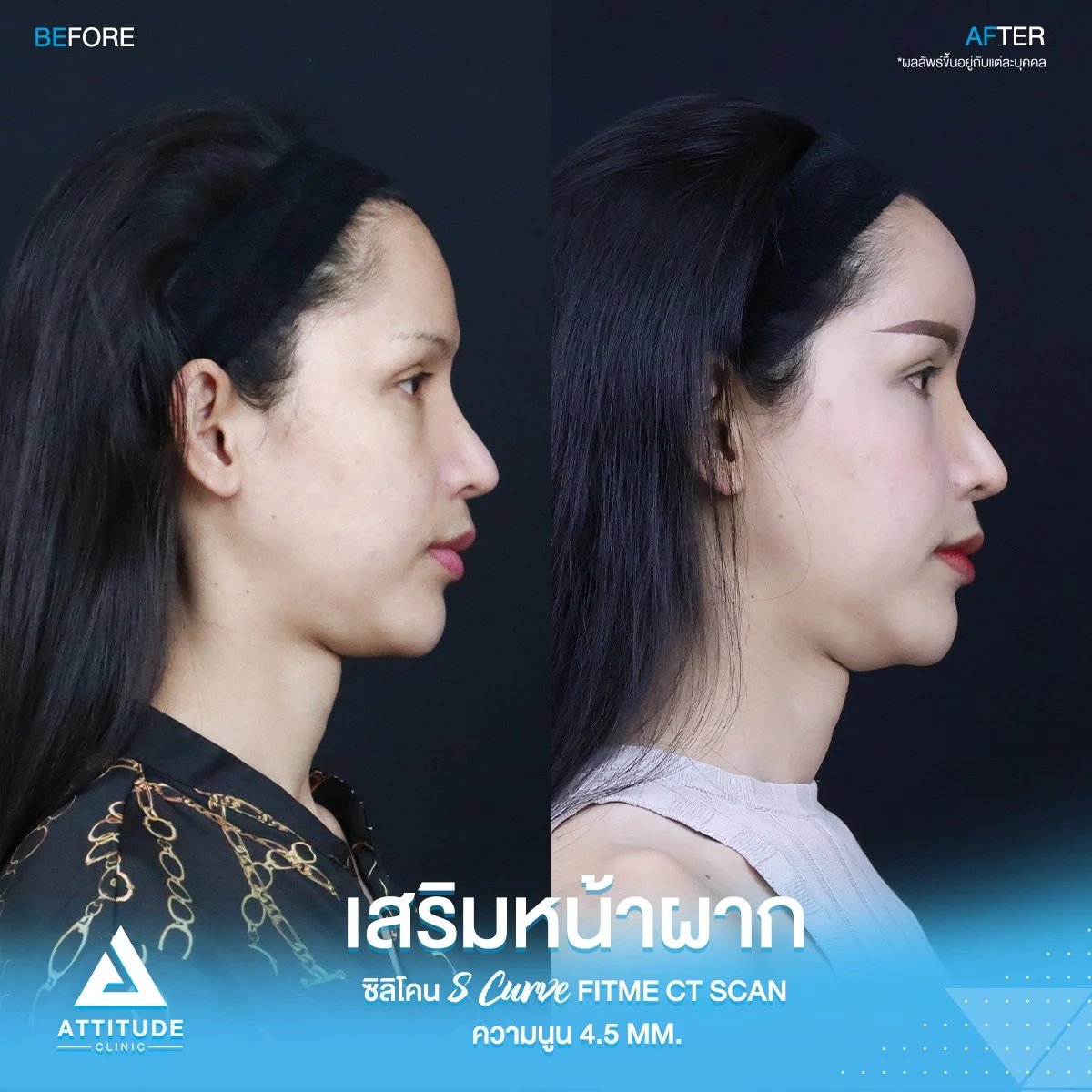 เสริมหน้ผาก