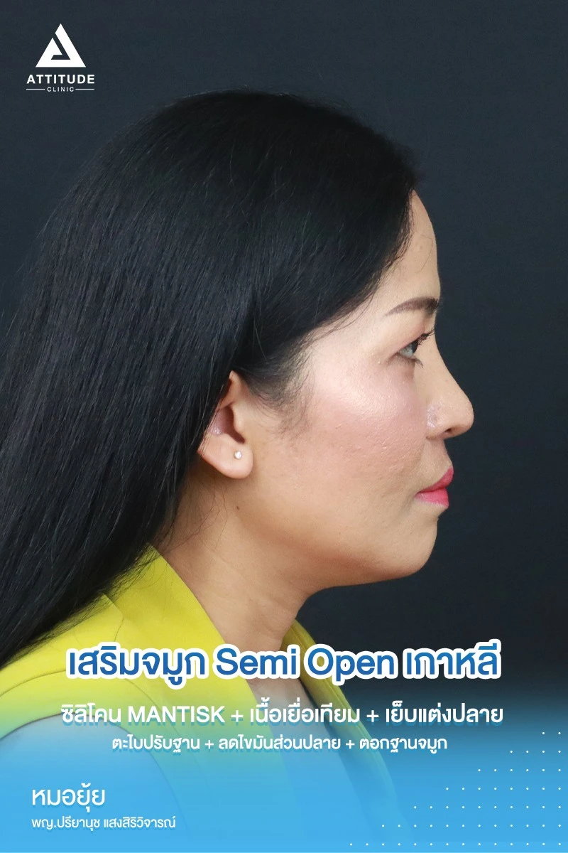 เสริมจมูก