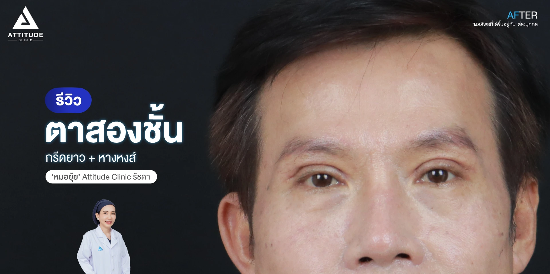 รีวิวทำตาสองชั้น