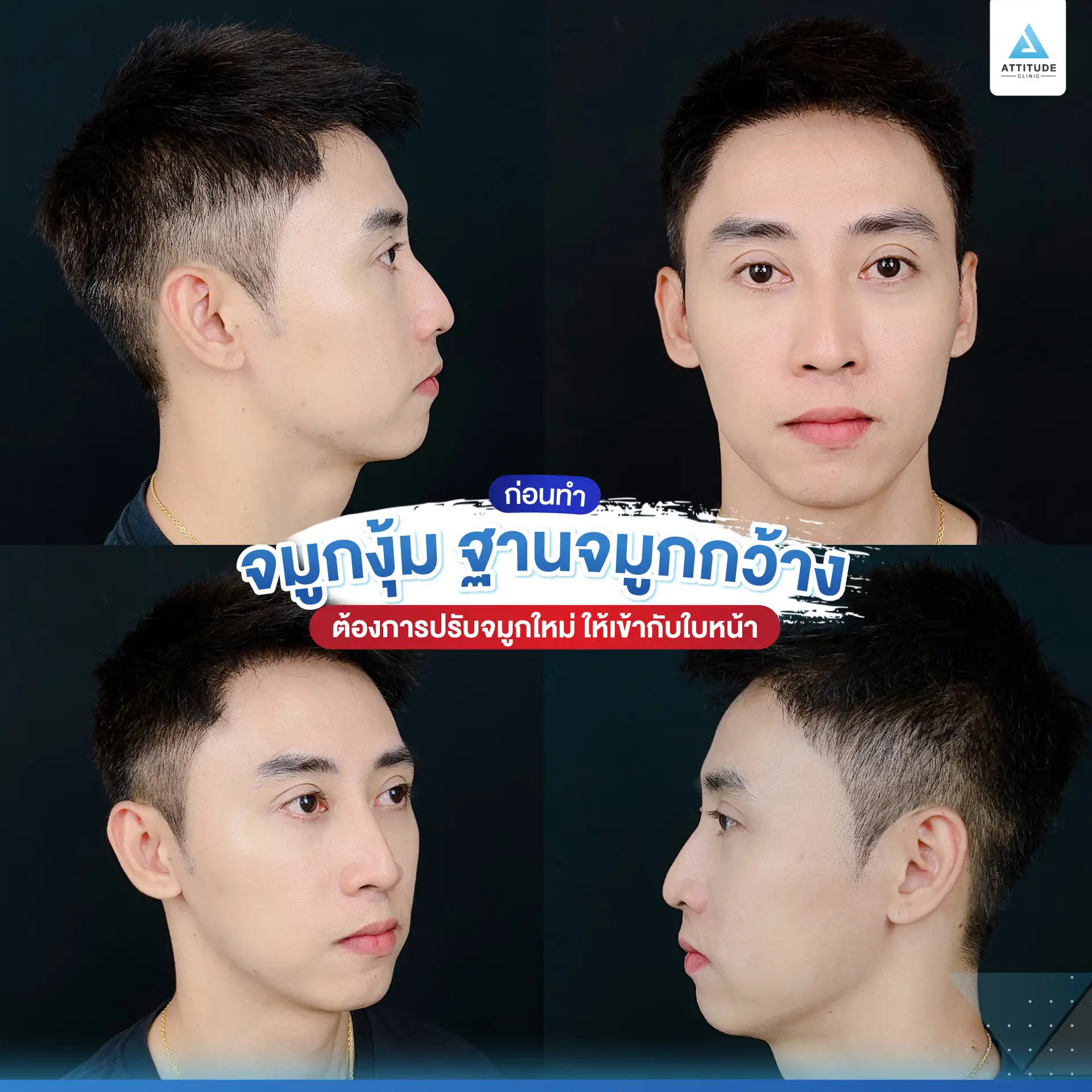 เสริมจมูก