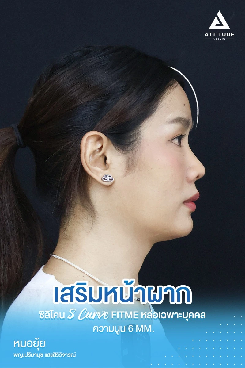 เสริมหน้าผาก