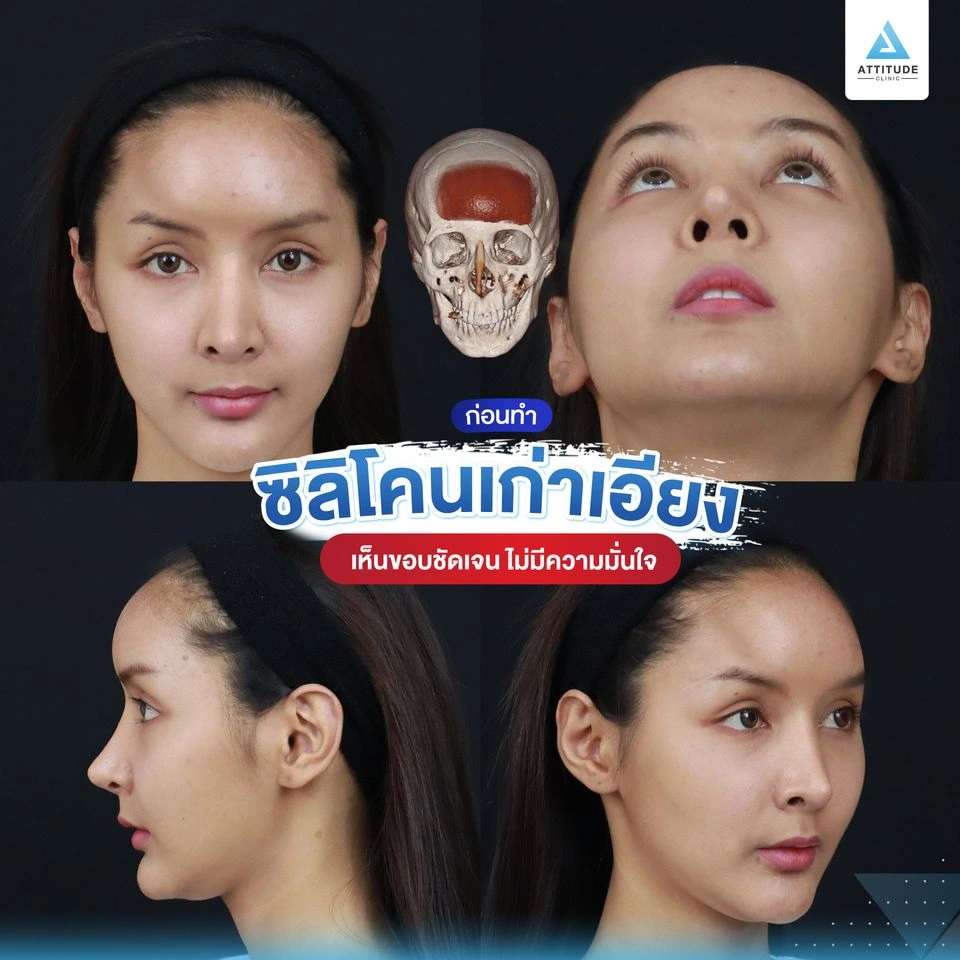 เสริมหน้าผาก