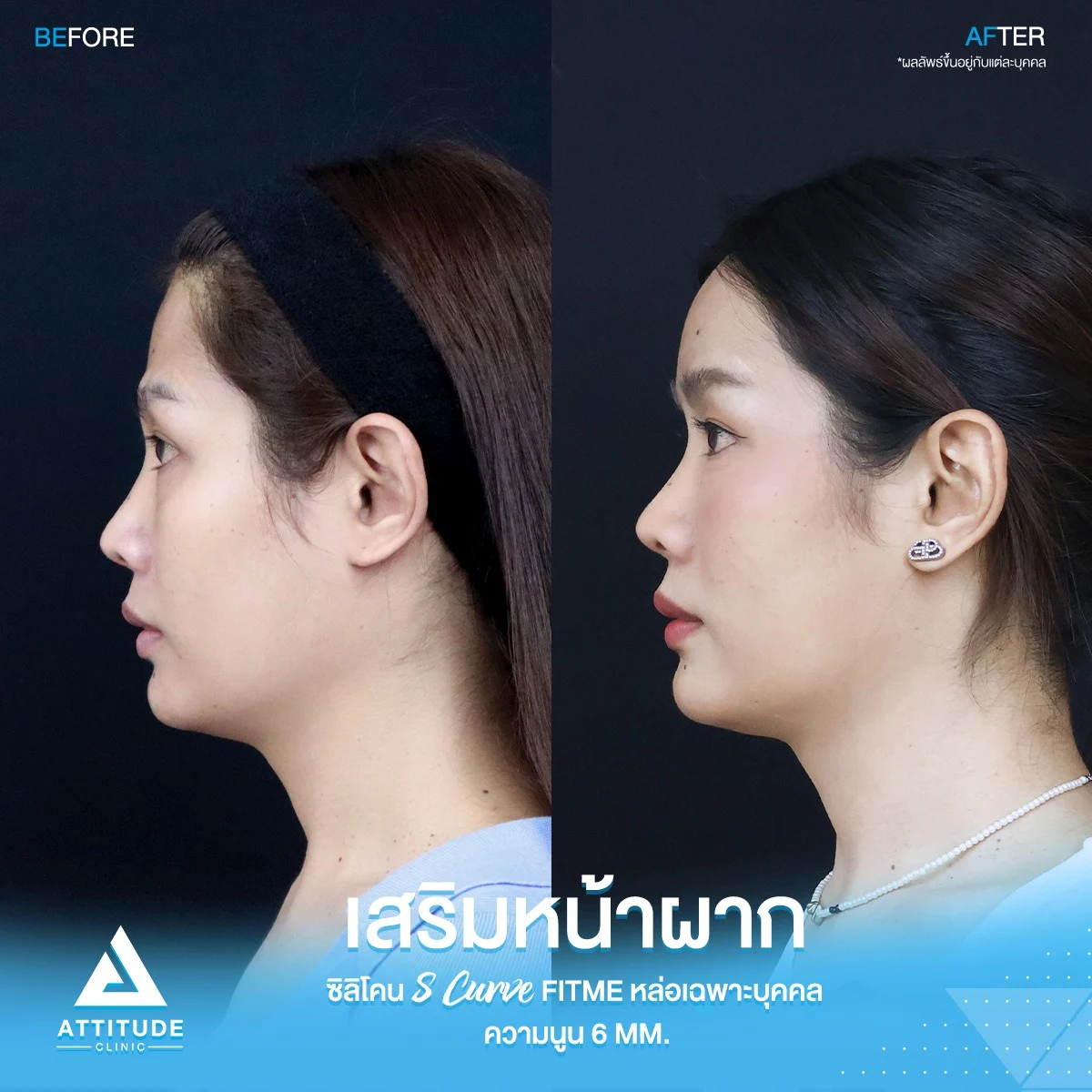 เสริมหน้าผาก
