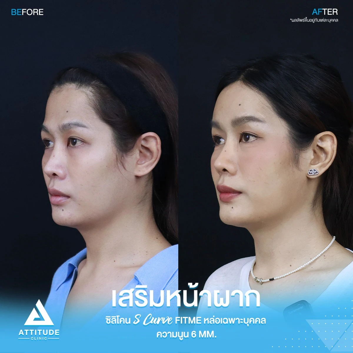 เสริมหน้าผาก
