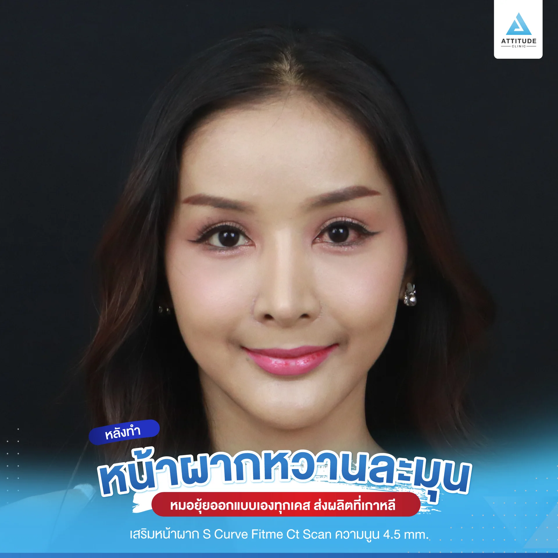เสริมหน้าผาก