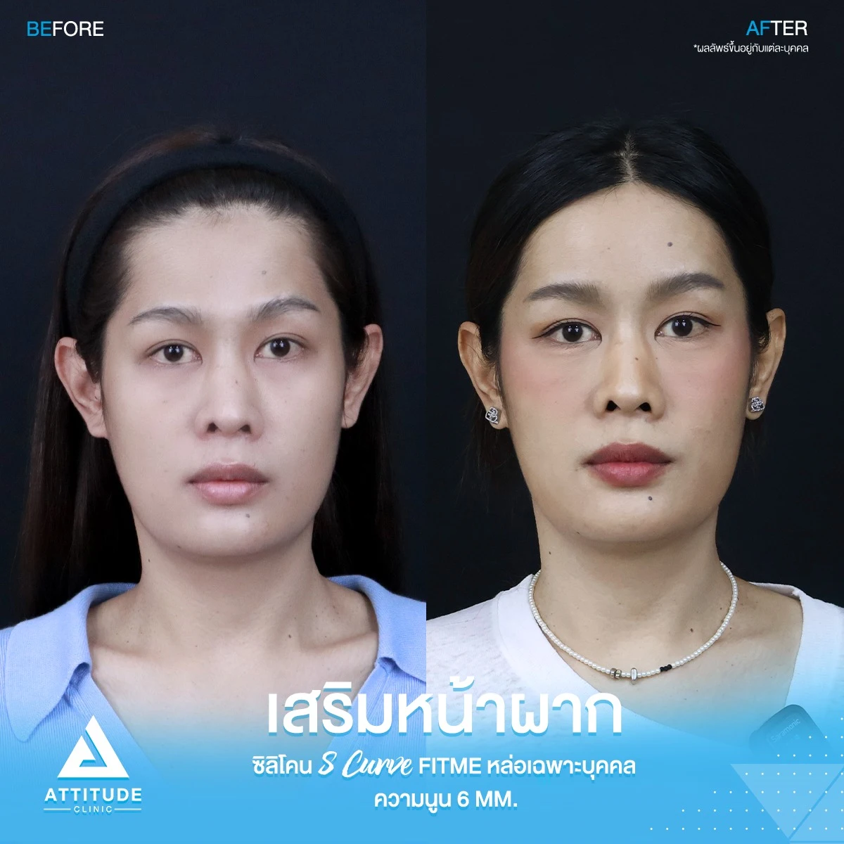 เสริมหน้าผาก