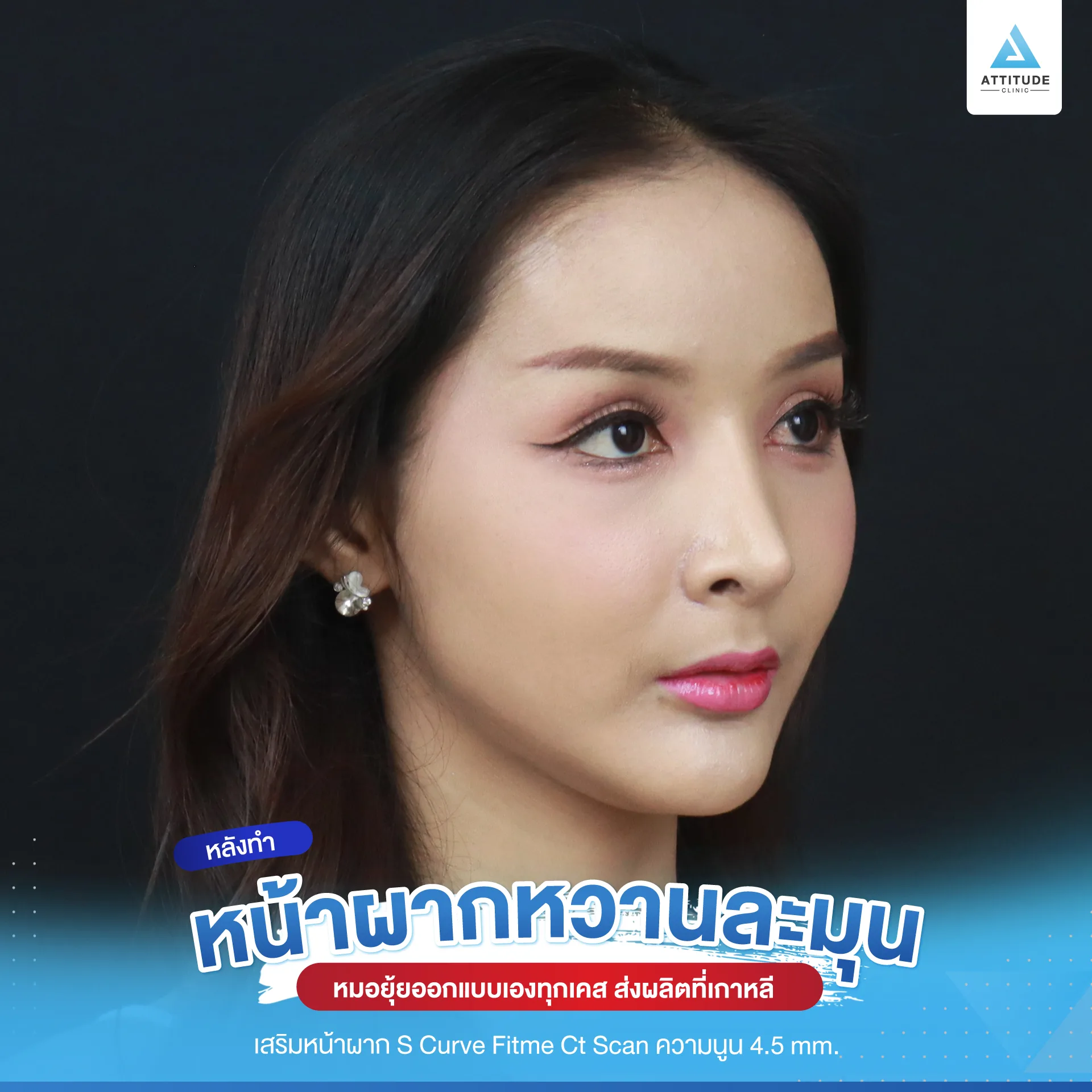 เสริมหน้าผาก