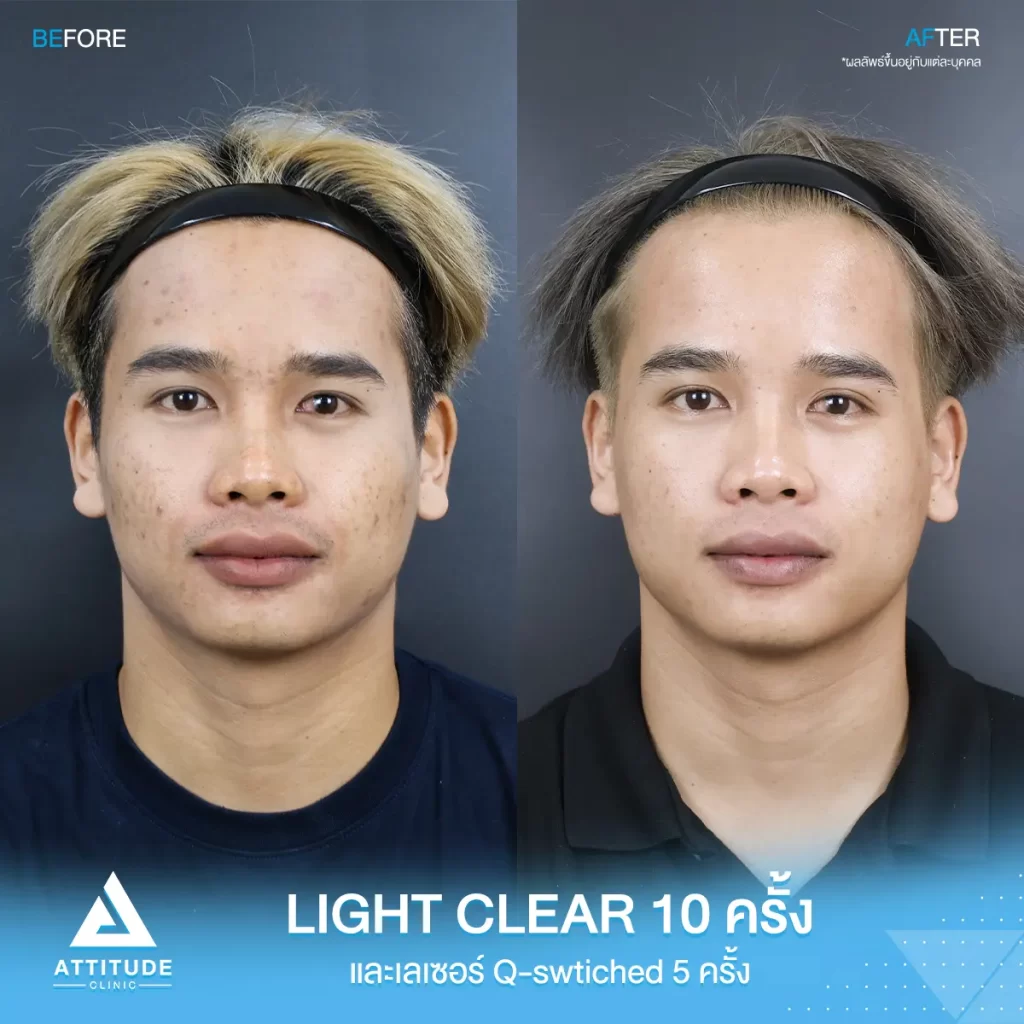 รีวิวรักษาสิวโปรแกรม Light Clear ฉายแสงรักษาสิว 7 ขั้นตอน จำนวน 10 ครั้ง เลเซอร์ลดจุดด่างดำ Q-Switched จำนวน 5 ครั้ง ของคุณปราโมทย์ มีปัญหาสิว รอยสิว ที่ Attitude Clinic