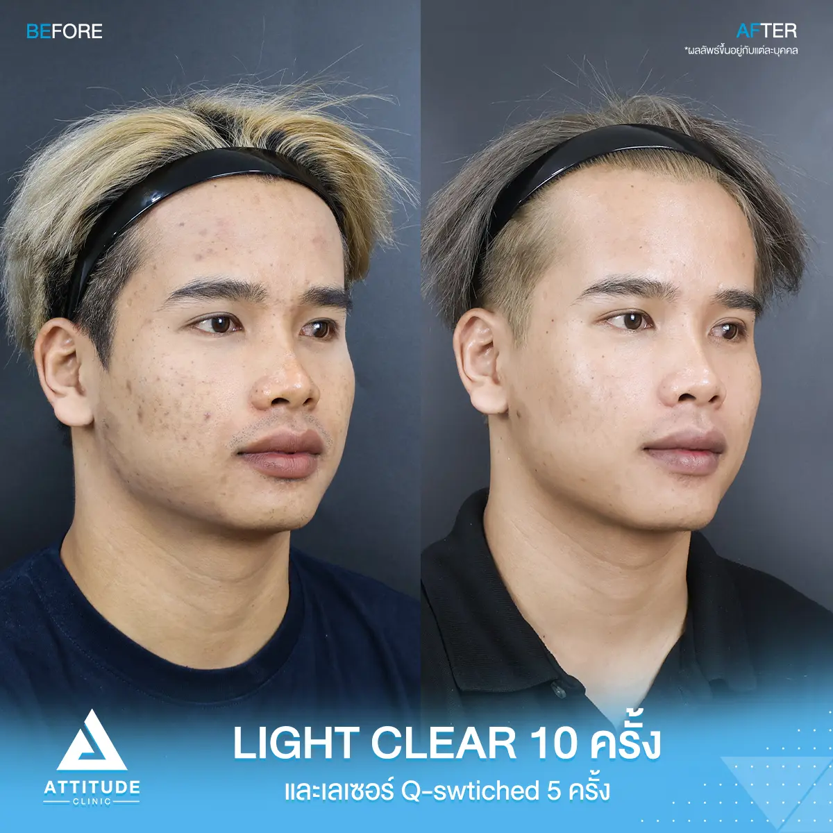 รีวิวรักษาสิวโปรแกรม Light Clear ฉายแสงรักษาสิว  7 ขั้นตอน จำนวน 10 ครั้ง เลเซอร์ลดจุดด่างดำ Q-Switched จำนวน 5 ครั้ง ของคุณปราโมทย์ มีปัญหาสิว รอยสิว ที่ Attitude Clinic 