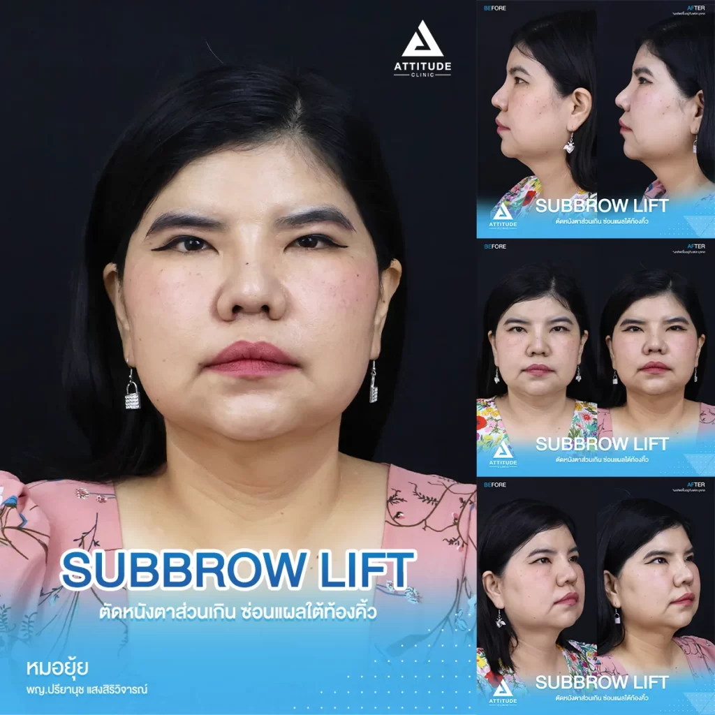 Sub Brow Lift