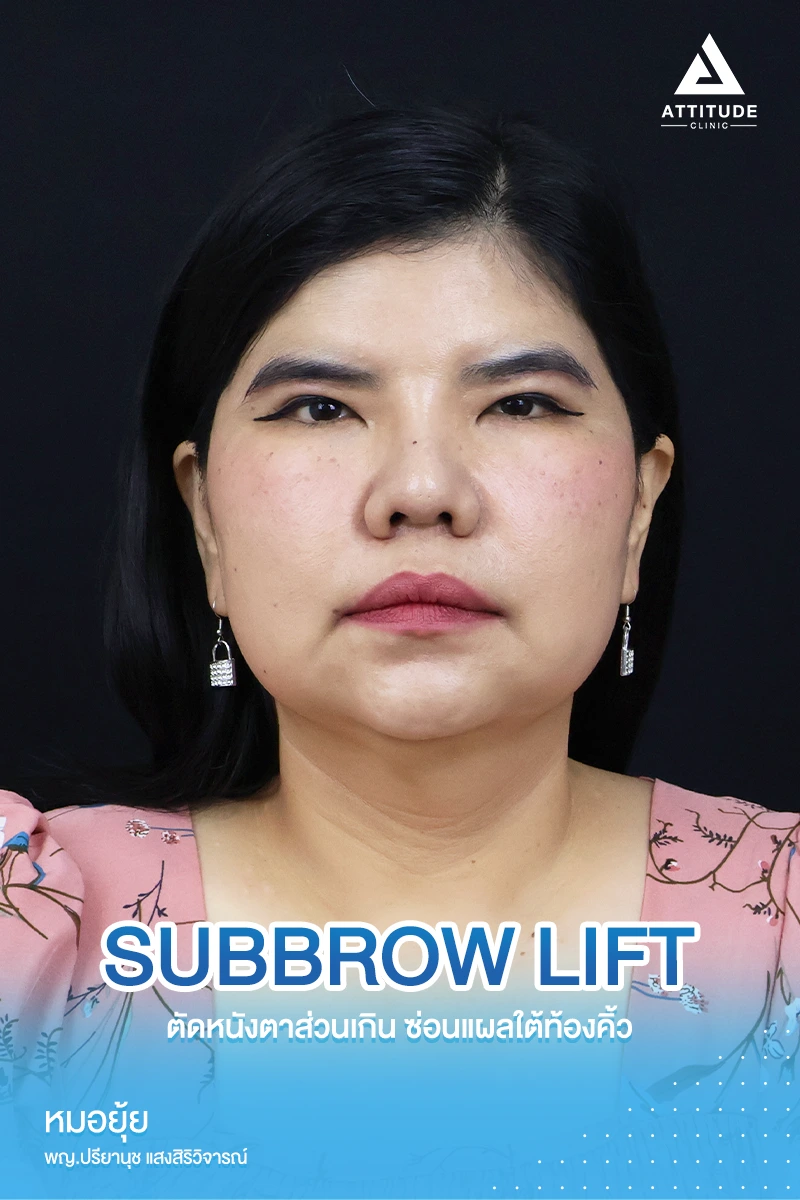 Sub Brow Lift