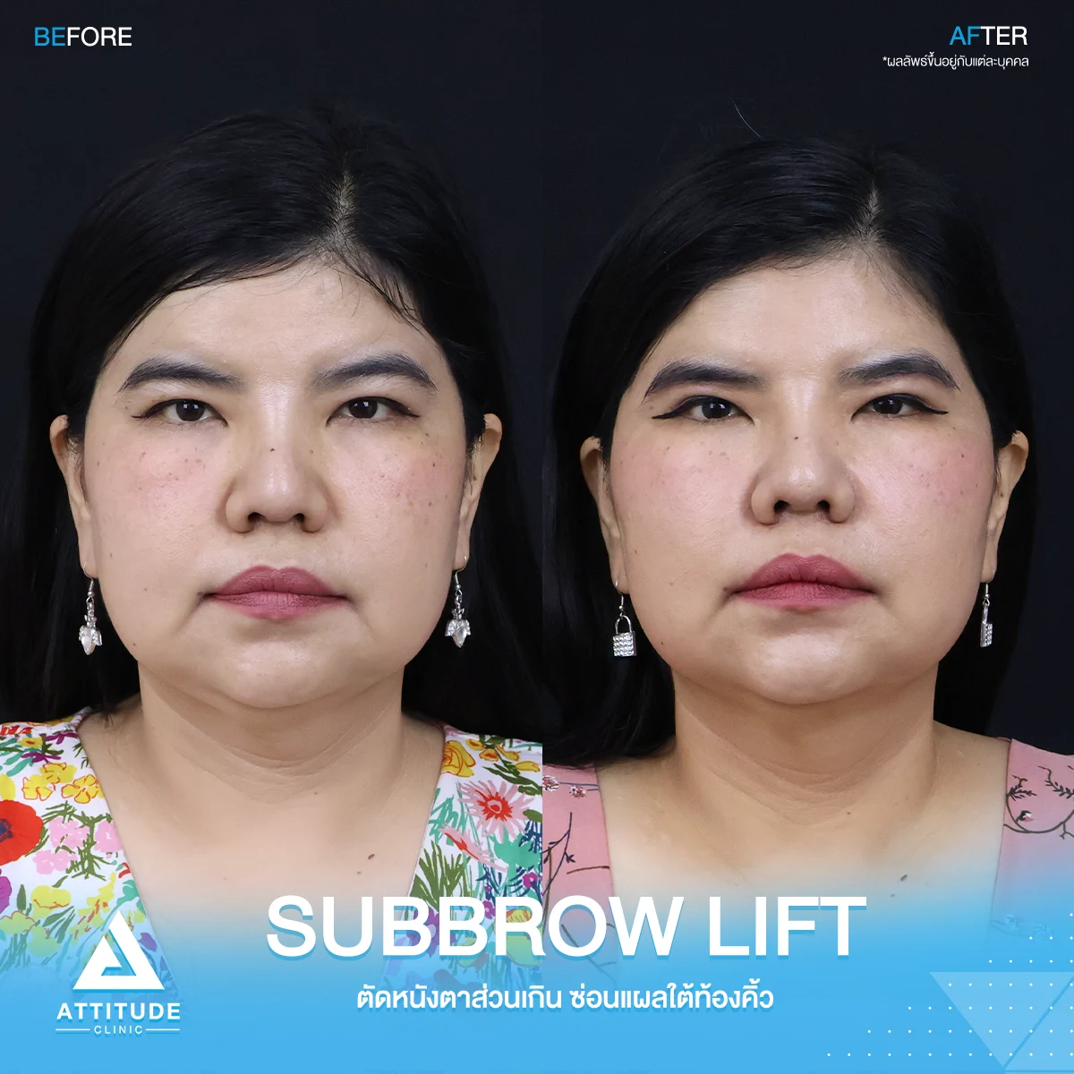 Sub Brow Lift