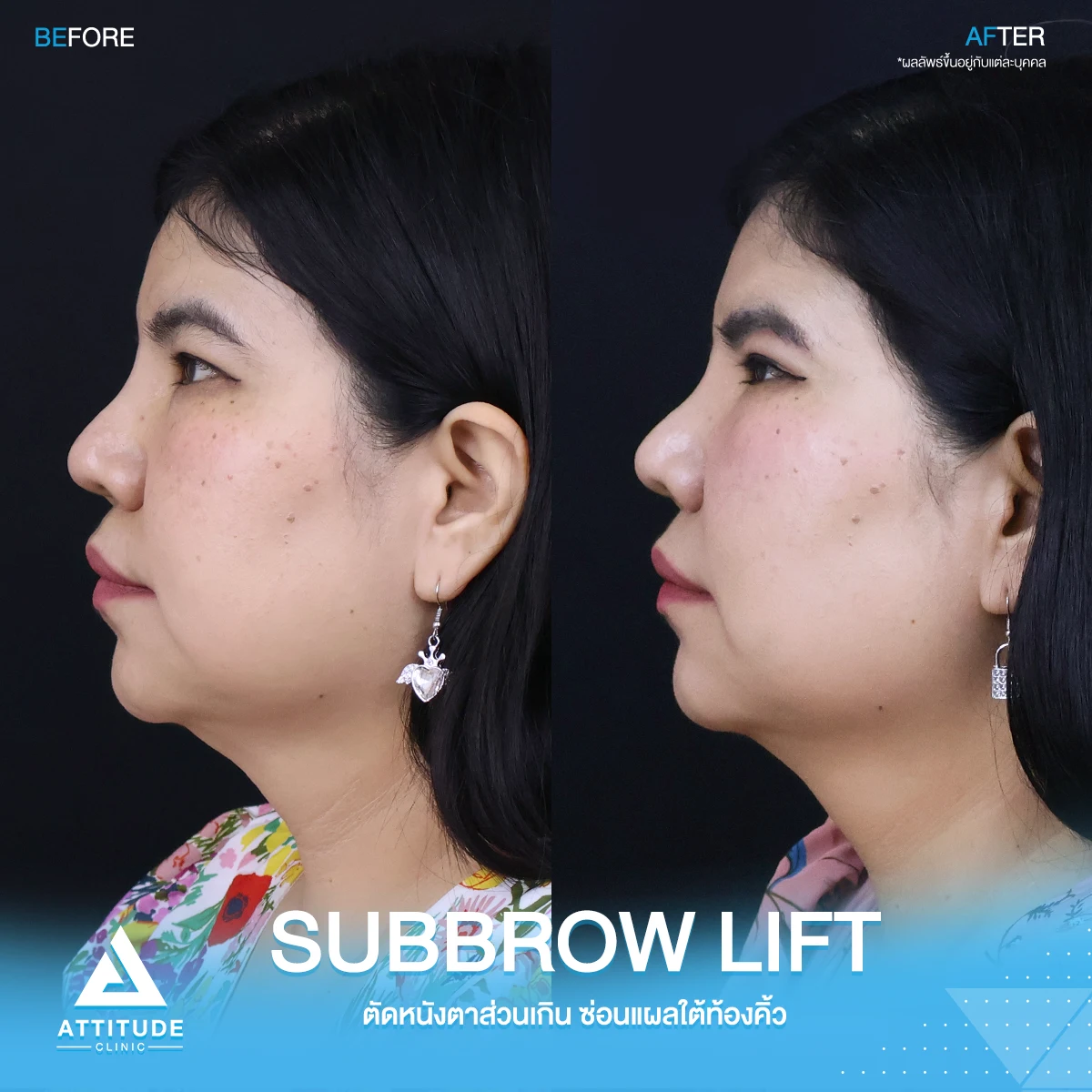 Sub Brow Lift