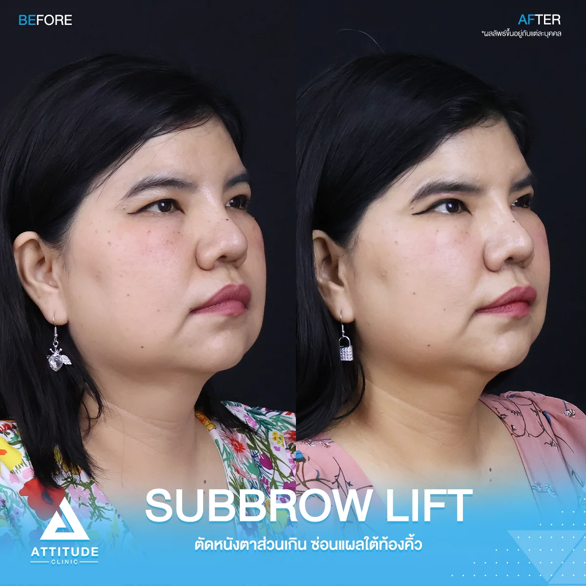 Sub Brow Lift