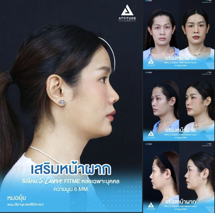 เสริมหน้าผาก