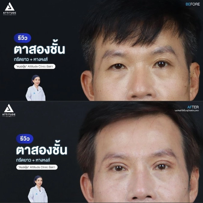 รีวิวทำตาสองชั้น