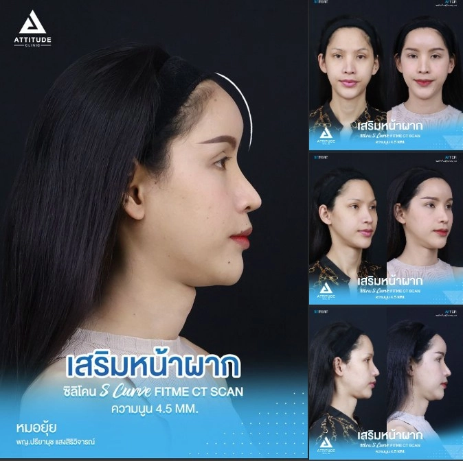 เสริมหน้าผาก