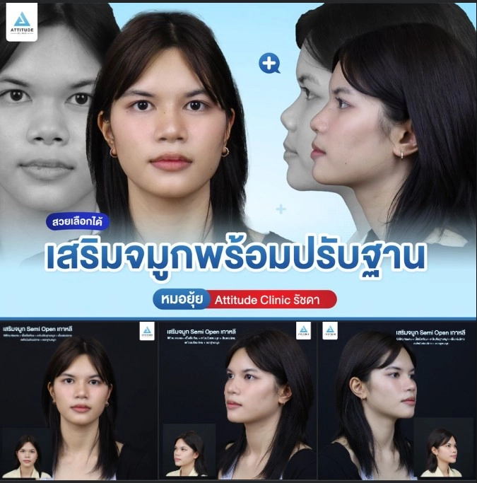 เสริมจมูก