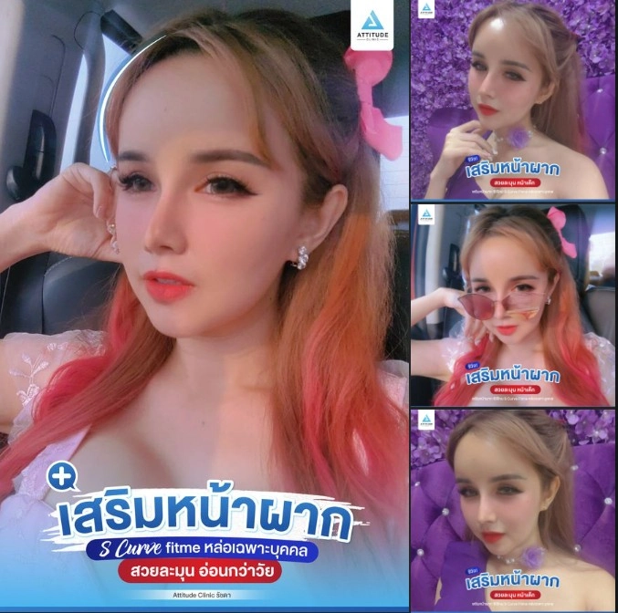 เสริมหน้าผาก