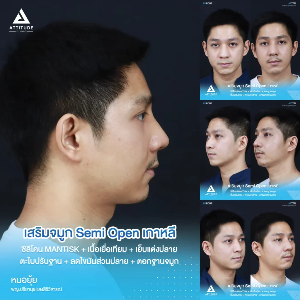เสริมจมูก